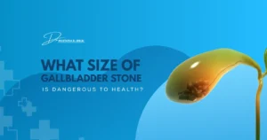 What Size of Gallbladder Stone Is Dangerous to Health?