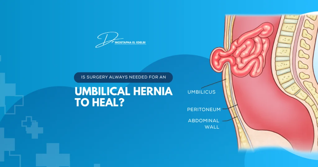 Is-Surgery-Always-Needed-for-an-Umbilical-Hernia-to-Heal